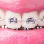 T_0318_braces-orthodontics_9235399.2e16d0ba.fill-640x229