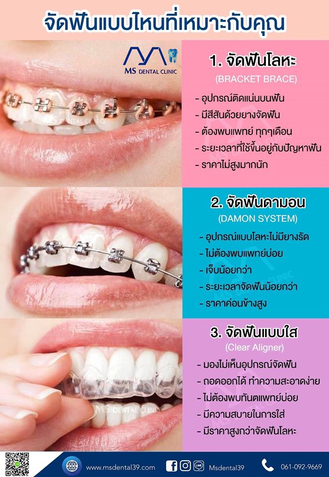 จัดฟันราคา